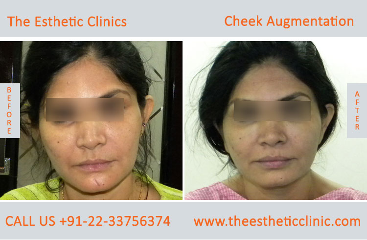 Cheek Augmentation, Cheek Implants surgery before after photos in mumbai india (7)